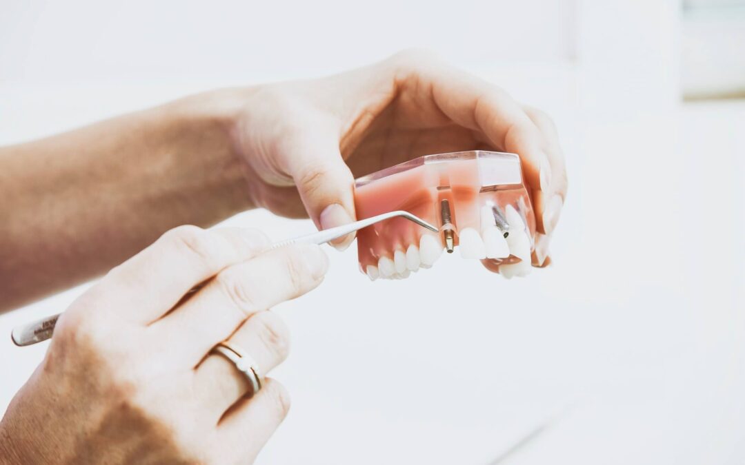 Reasons to Consider Dental Implants