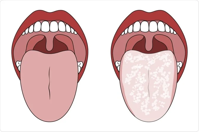 An illustration of oral thrush; one cause of white film in the mouth