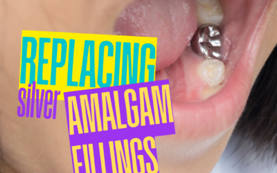 Replacing Silver Amalgam Fillings